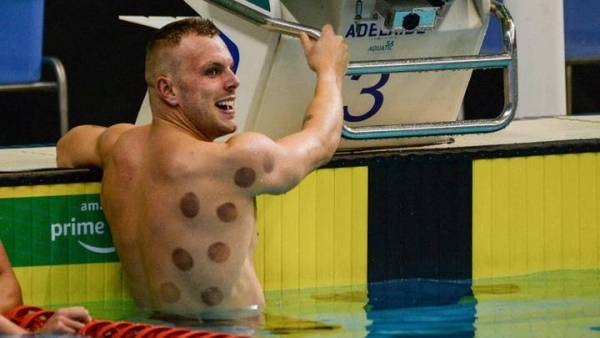 أولمبياد طوكيو.. لماذا يلجأ الرياضيون إلى الحجامة قبل خوض المسابقات؟