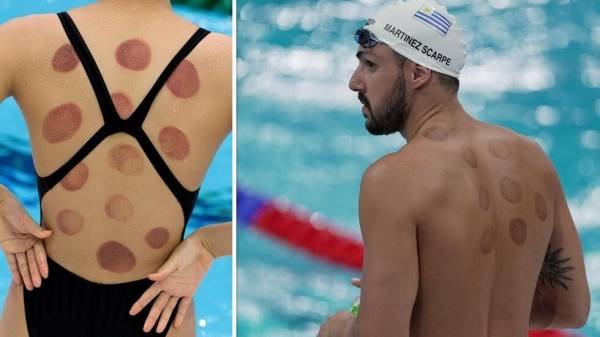 رياضيون يستعملون الحجامة في طوكيو