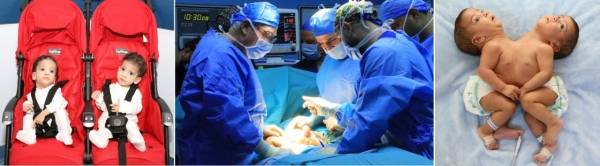 المستشفى التخصصي يسجل أول عملية ناجحة لفصل توأم سيامي ملتصق في الأردن (صور)