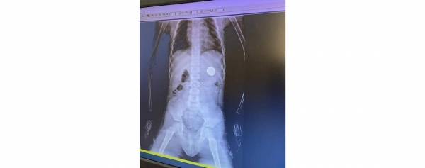 د.ابو رمان : استخراج ربع دينار معدني من معدة طفل عمره 5 سنوات