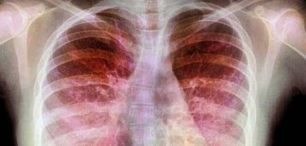 على مكتب وزير الصحة .. طبيب صدرية لا يحمل بورد أردني ويمارس اختصاصه منذ 20 عاماً ؟!