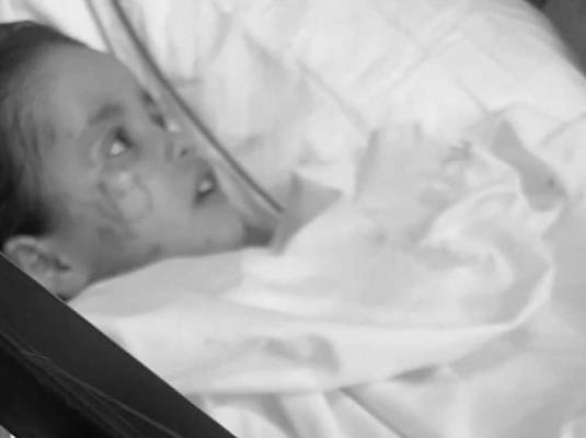 جريمة مروِّعة .. شخص يحرق زوجته بالأسيد في السعودية