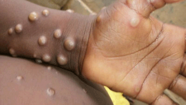 ماذا يعني اعلان الصحة العالمية جدري القرود حالة طارئة؟