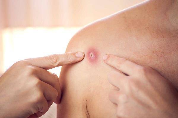 الاتحاد الأوروبي يوافق على استخدام إمفانكس ضد جدري القردة