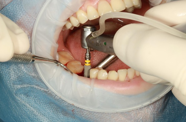 كيف تتم عملية زراعة الأسنان؟