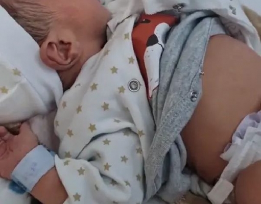 ولادة نادرة جدًا.. مولود يحمل توأمه في بطنه