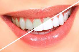 طبيعية وفعالة.. 5 حيل لتبييض الأسنان