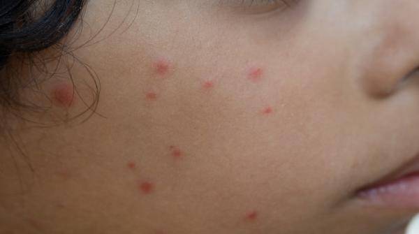 عدد مصابي جدري الماء في الأردن العام الماضي الأعلى منذ 5 سنوات