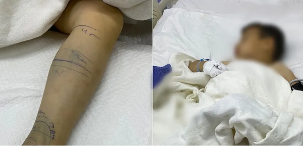 تفاصيل لحظات تحبس الأنفاس لإنقاذ حياة طفل لدغته أفعى فلسطين السامة