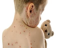 الطراونة يرجع أسباب تفشي الحصبة لموجات اللجوء والبنية الصحية