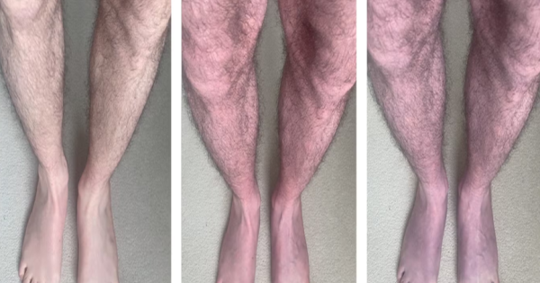 عانى رجل بريطاني من تبدل لون ساقيه إلى الأرجواني وأخضع إلى فحوص مكثفة أثبتت إصابته بكوفيد الطويل الأمد... إليكم القصة