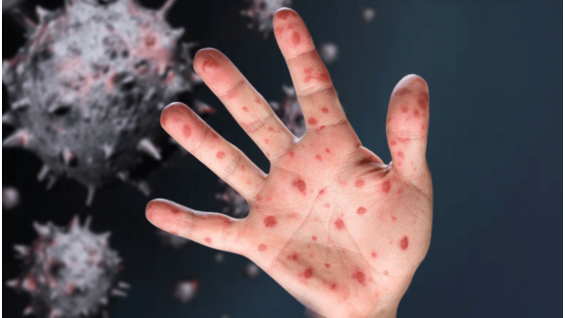 مكافحة الأوبئة: لا إصابات بجدري القردة في الأردن