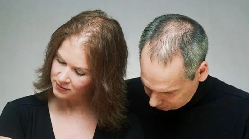 لا داعي للزراعة.. اكتشاف علاج طبيعي لتساقط الشعر