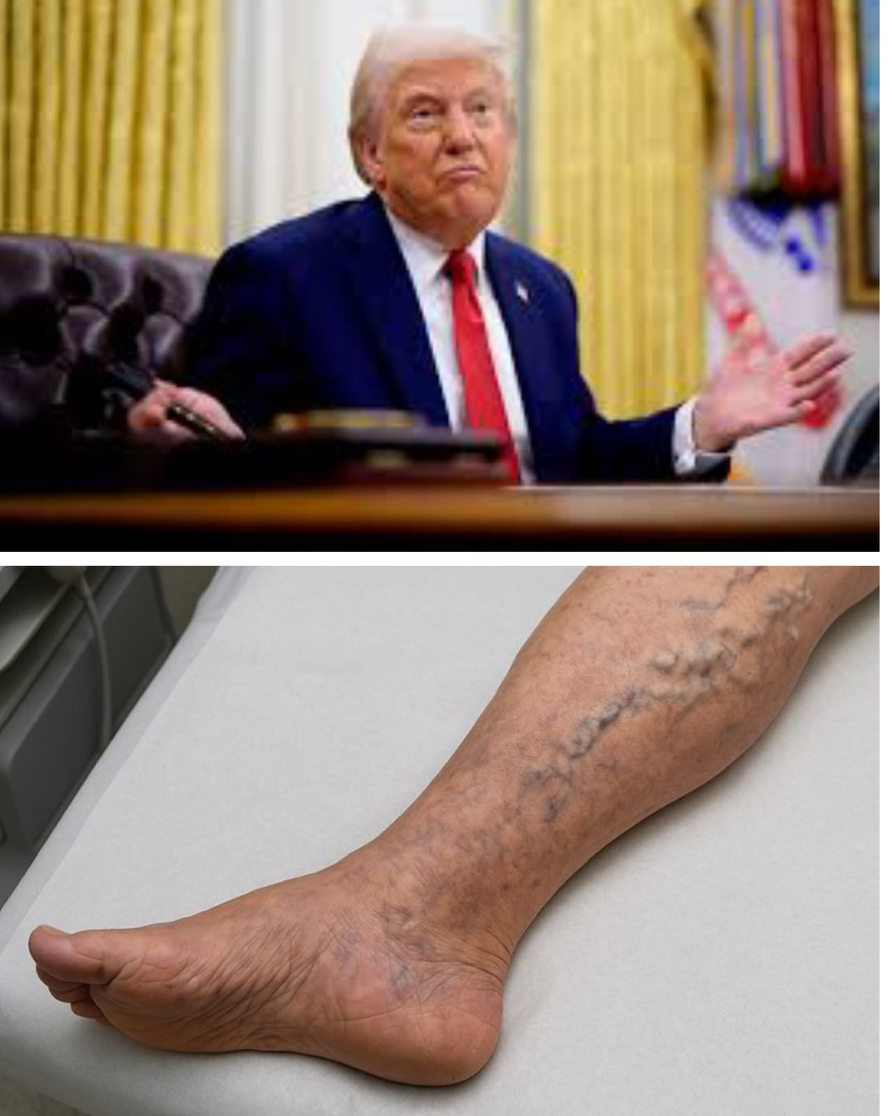 ما هو القصور الوريدي المزمن الذي اصيب به الرئيس الأميركي ترمب؟