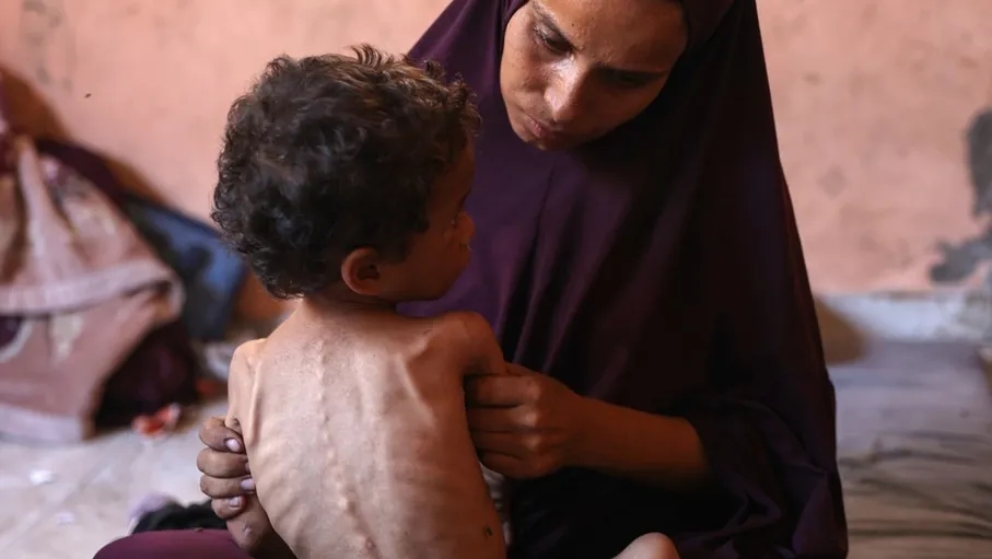 سوء التغذية الحاد يطال 17 ألف طفل في غزة