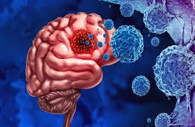 روائح غير عادية قد تشير إلى وجود ورم في الدماغ