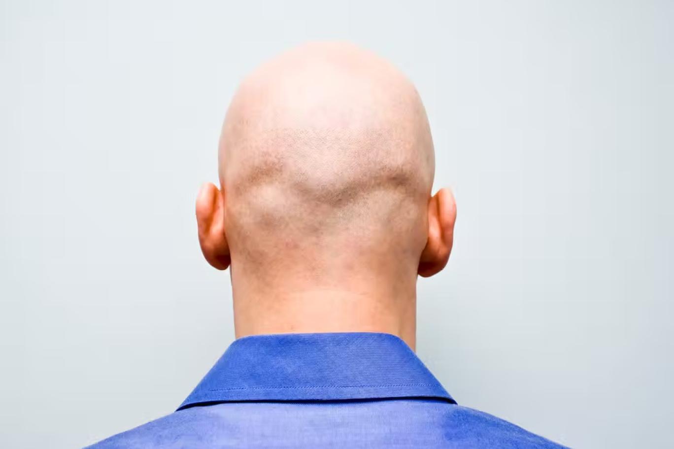 نعت أحدهم بـ أصلع في مكان العمل يعد تحرشا جنسيا