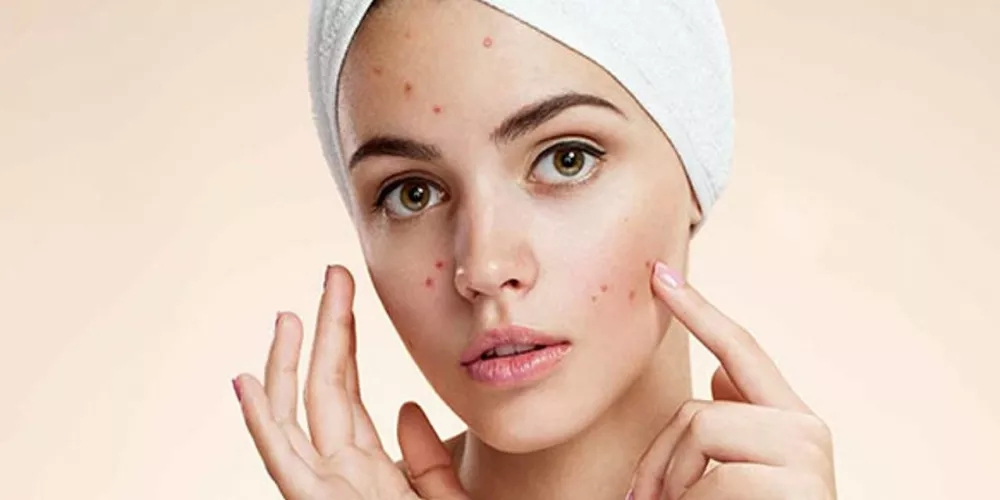 تحذير خطير: بثور الوجه في هذه المنطقة قد تودي بحياتك