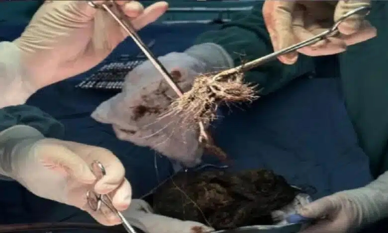 واقعة غريبة.. الاطباء يستخرجون 2 كيلو شعر من معدة فتاة