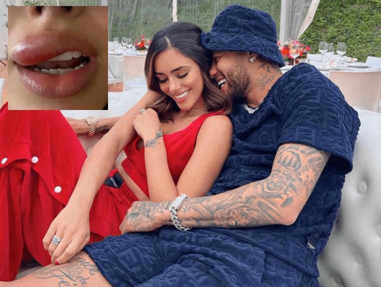 صديقة نيمار .. حب الشباب يضرب وجهها وينشر عدوى بكتيرية