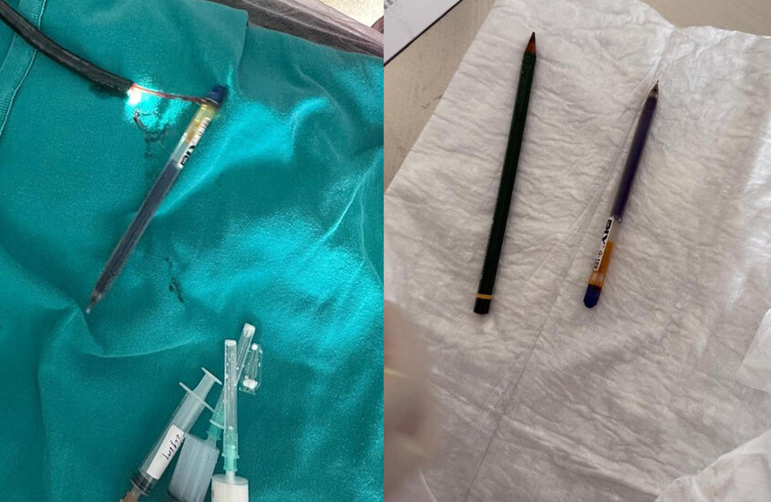 بسبب اضطراب نادر.. استخراج قلمين من معدة شابة تركية! (صور)