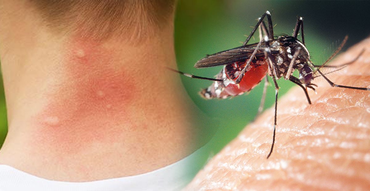 الأكثر عرضة لـ لسعات البعوض  من يشرب الكحول ويدخن القنب