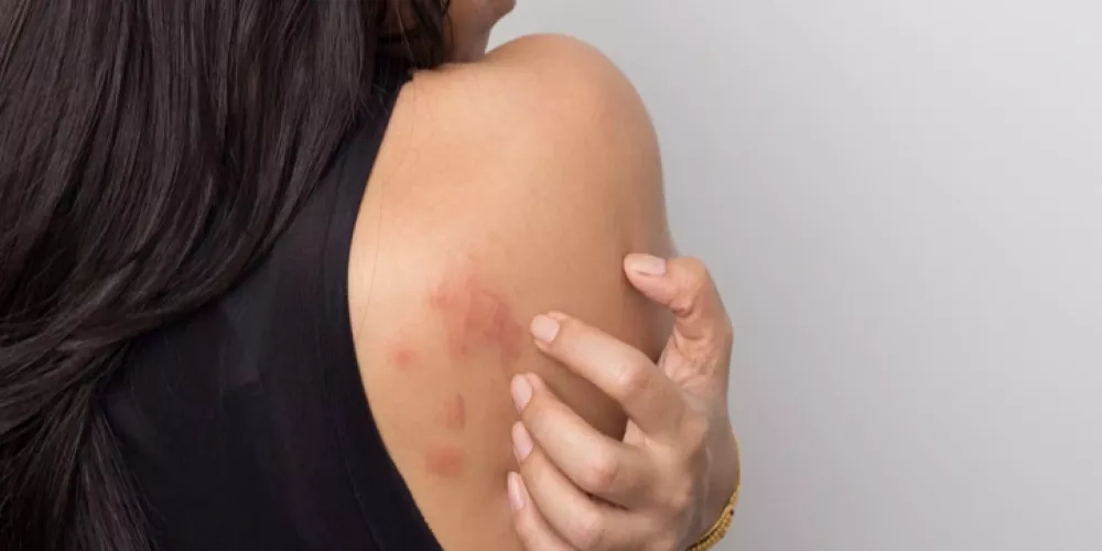 مشاكل الجلد قد تكون إنذارا مبكرا لاضطرابات نفسية خفية