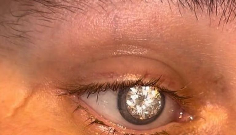 تاجر مجوهرات يزرع ألماسة بمليوني دولار في عينه