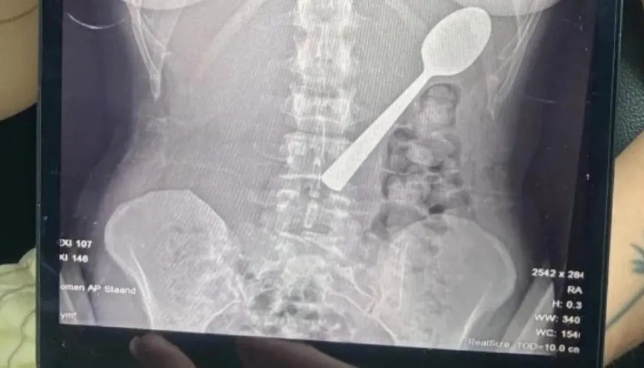 سيدة تبتلع ملعقة طولها 17 سنتيمتراً عن طريق الخطأ