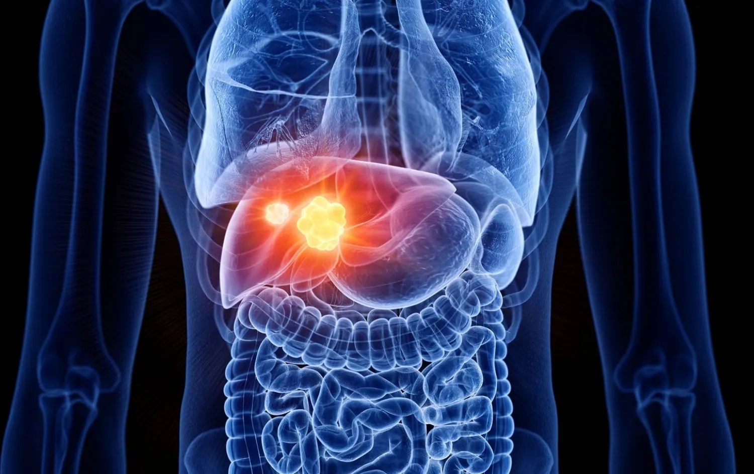 طريقة واعدة لعلاج سرطان الكبد