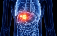 طريقة واعدة لعلاج سرطان الكبد