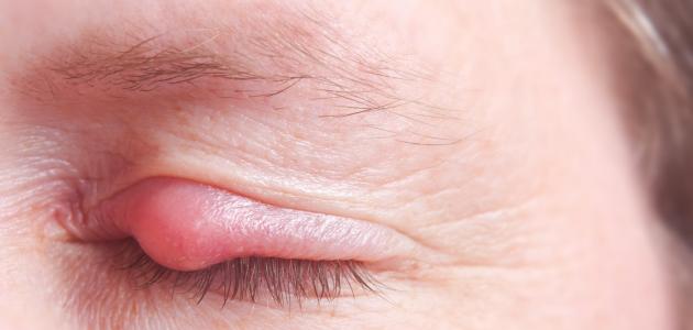 التهاب الجفن: الأعراض، الأسباب، والتشخيص