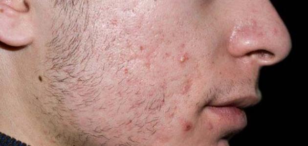 طرق فعالة لعلاج حب الشباب للبشرة الدهنية بسرعة