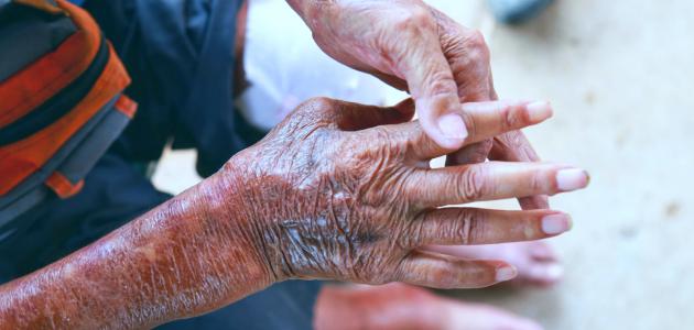 تليّف الجلد: الأسباب والأنواع والتأثيرات