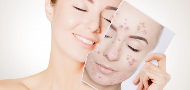 طرق طبيعية للتخلص من حب الشباب وآثاره