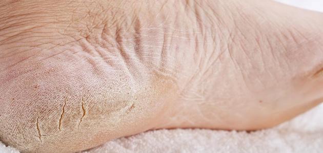 علاج التشقق: نصائح فعالة لترطيب الجلد