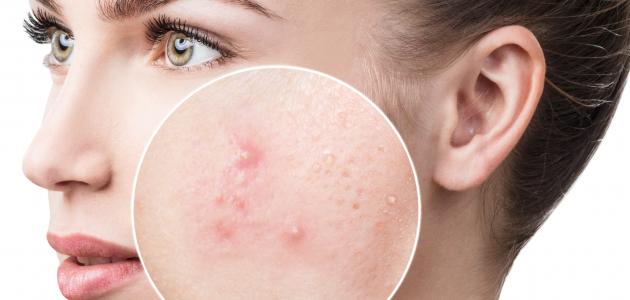 طرق فعالة للتخلص من حفر حب الشباب
