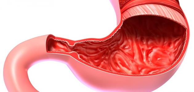 أعراض التهاب القولون التقرحي وأهم المعلومات حوله