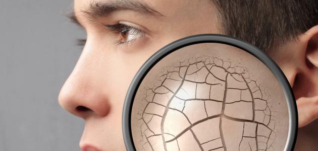 التشققات الجلدية: أسبابها وعلاجها الفعال