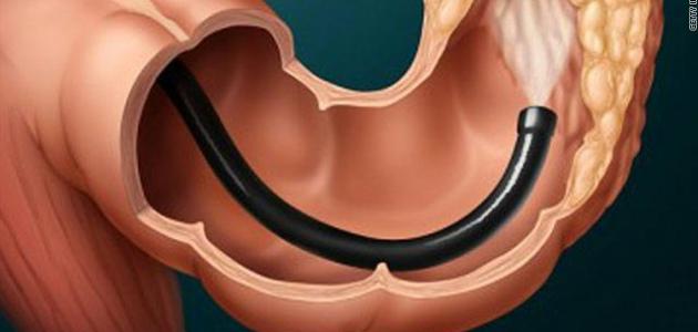 إجراء منظار القولون: تفاصيل وأسباب وطرق التنفيذ