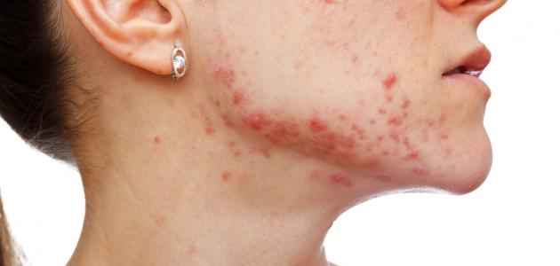 حب الشباب تحت الجلد: الأسباب والعلاج الطبيعي