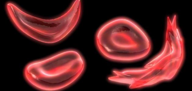 أعراض الأنيميا عند الأطفال وأنواعها