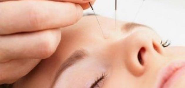 فوائد العلاج بالإبر الصينية ومخاطره