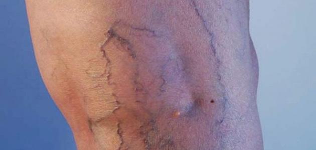 مرض الدوالي: الأسباب والأعراض والعلاج