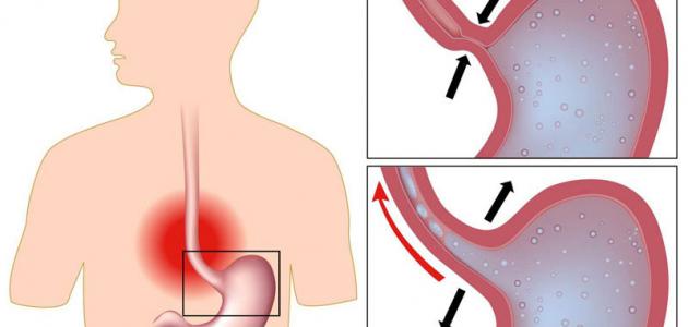 علاج فتق المعدة: الأعراض والأسباب والطرق العلاجية
