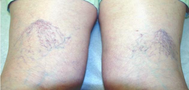 الليزر الوريدي والتردد الحراري في علاج دوالي الساقين