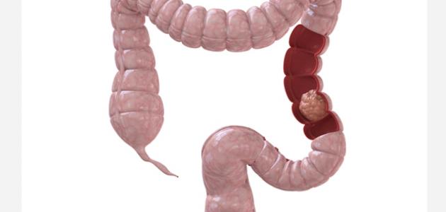 مخاطر وجود الدم في البراز وأسبابه