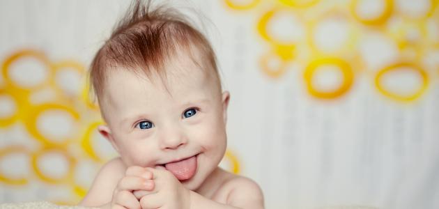 متلازمة داون: التعريف، الأنواع، والأسباب